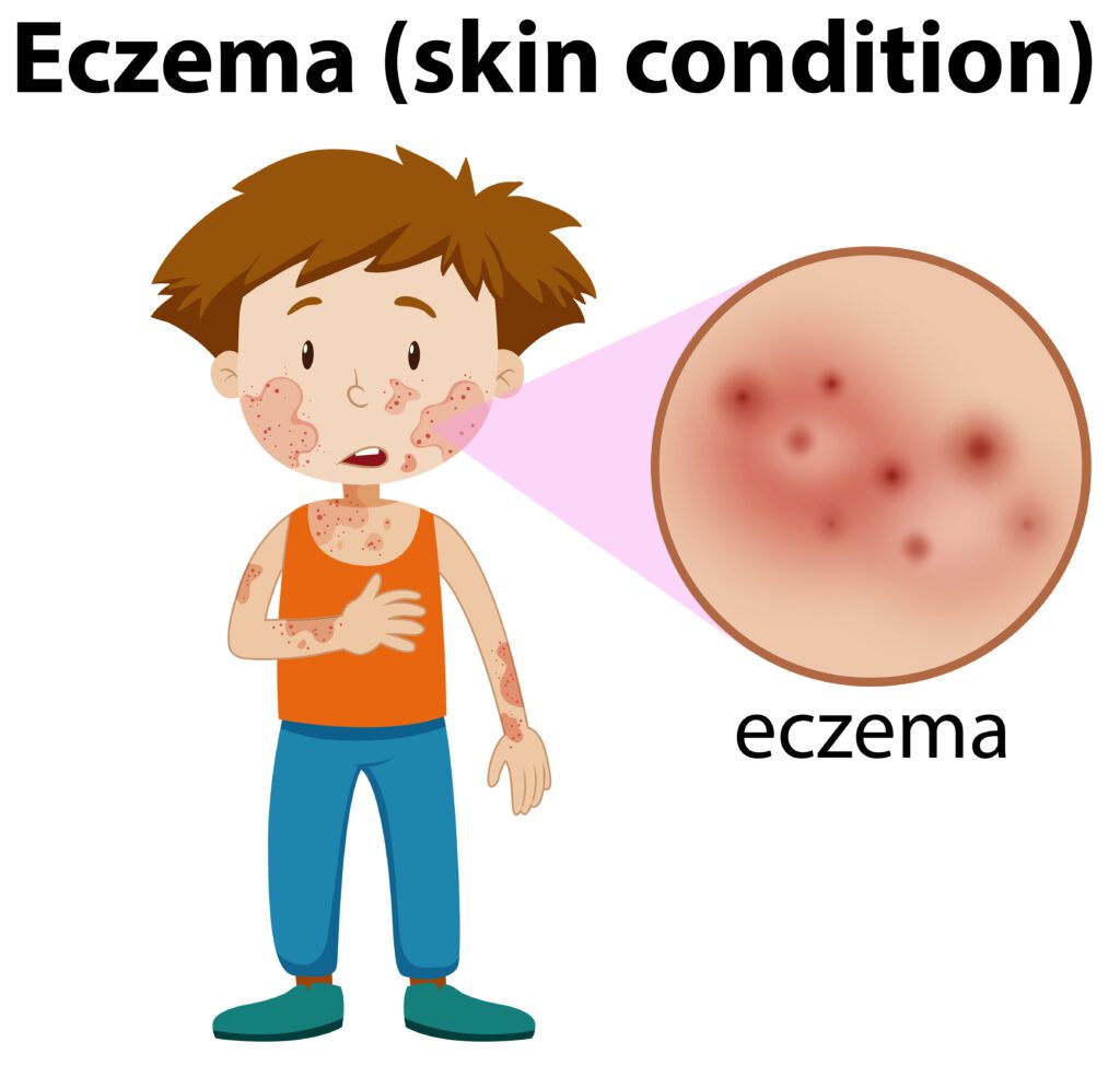 how to control eczema