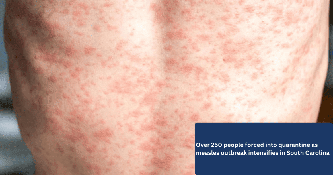 Over 250 people forced into quarantine as measles outbreak intensifies in South Carolina