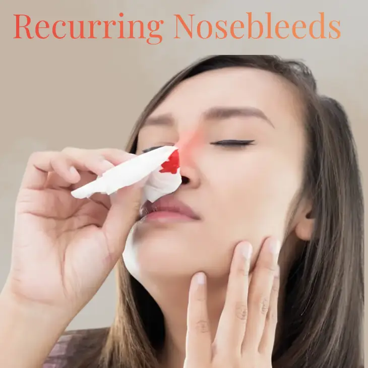 woman with nosebleed holding tissue to nose due to dry nasal passages
