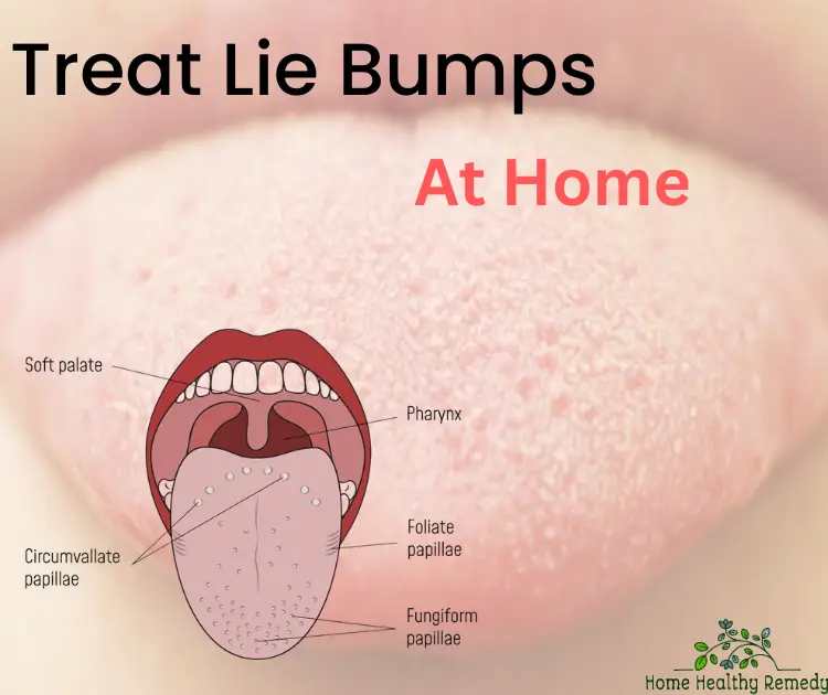 Treat lie bumps at home with a tongue anatomy illustration showing fungiform, foliate, and circumvallate papillae.